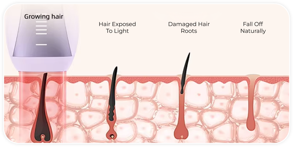 Hair Reduction Stages