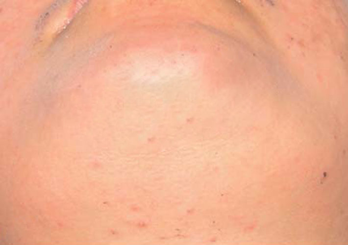 Before treatment