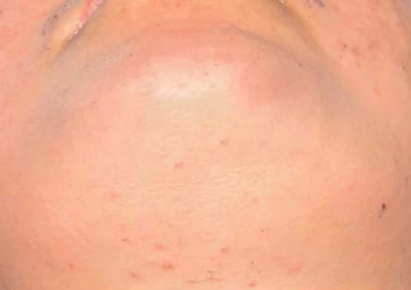 Before treatment
