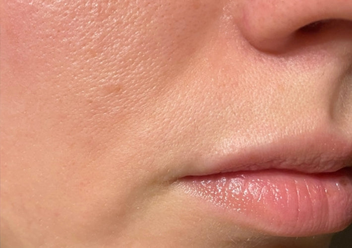 Before treatment