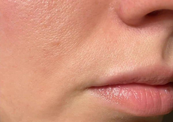 Before treatment