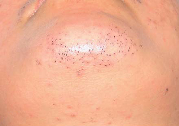 After treatment