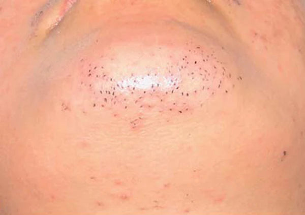 After treatment