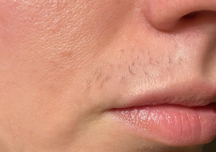 After treatment